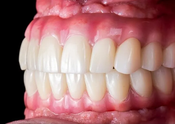 Hotová fixná náhrada na implantátoch — horný aj dolný oblúk v zhryze.