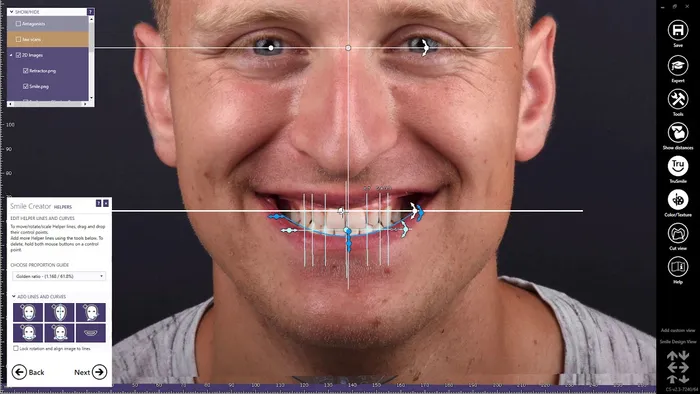 Návrh úsmevu v programe Exocad – tvar a postavenie nových predných zubov nakreslené cez fotografiu tváre pacienta, s pomocnými líniami a proporciami.